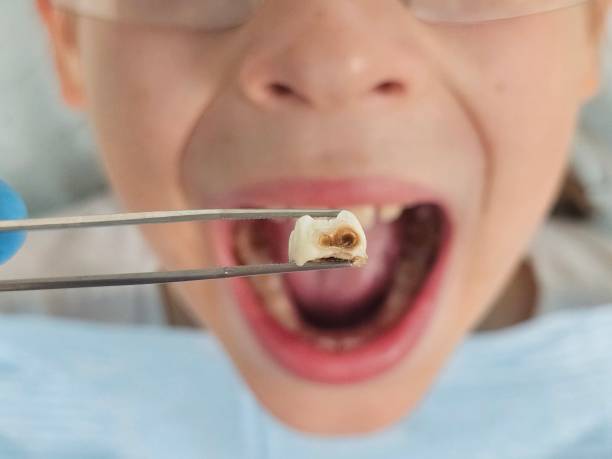 Best Emergency Dentist for Lost Fillings or Crowns in Waynesboro, TN
